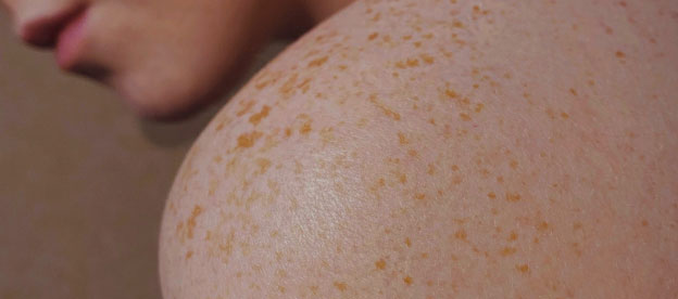 Image of bare freckly shoulder